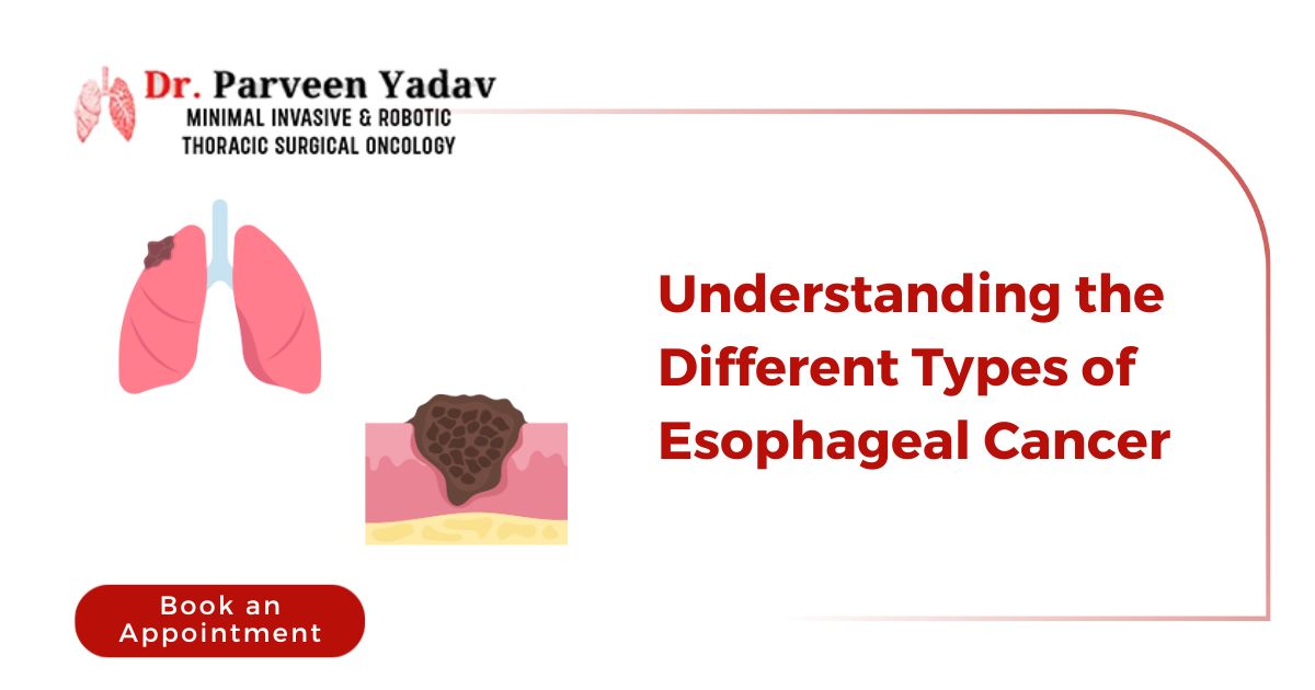 Understanding the Different Types of Esophageal Cancer