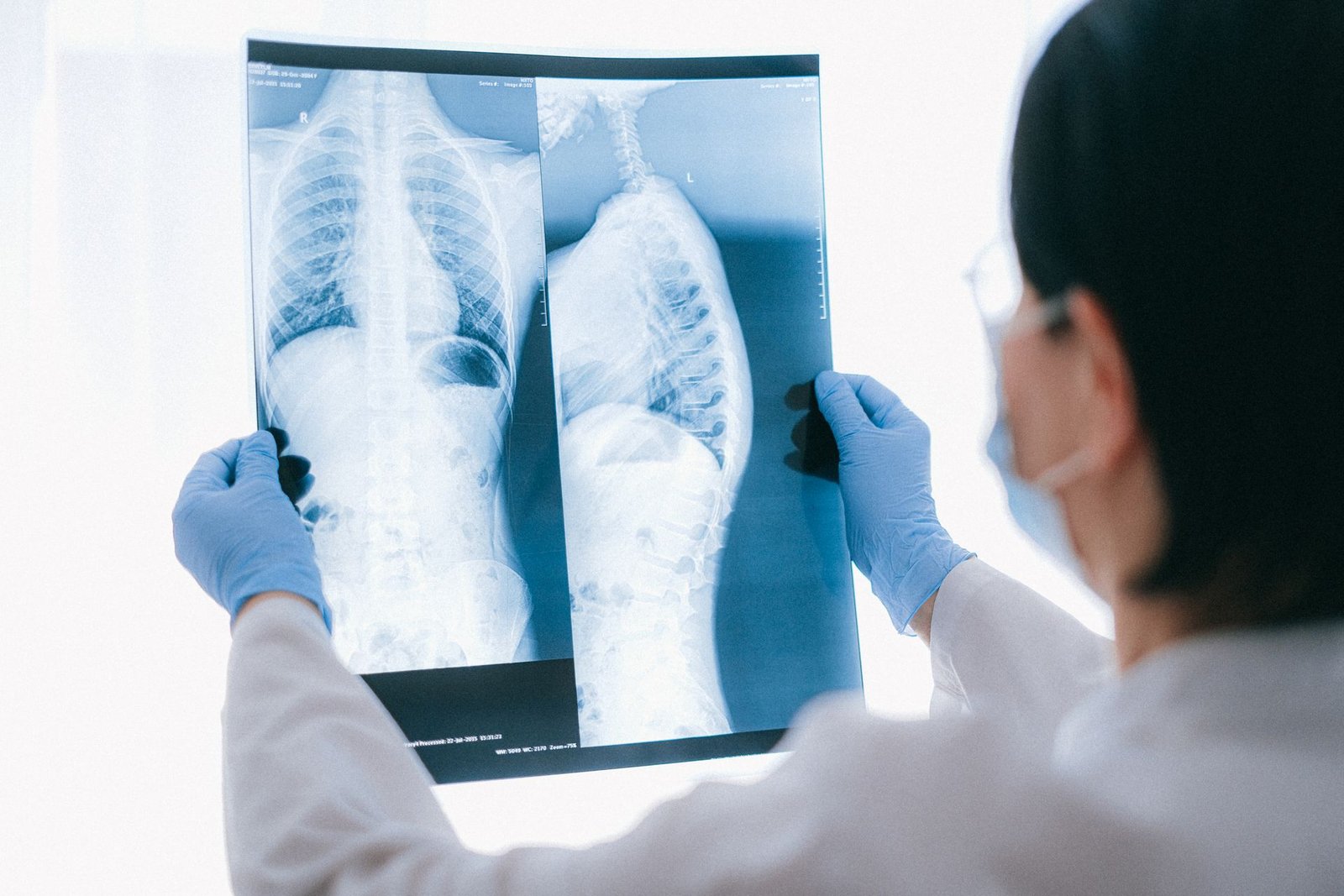 Lung Cancer: Why a 2nd Opinion Could Save Your Life
